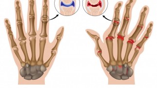 Understanding Rheumatoid Arthritis: Symptoms, Causes, and Treatment Options Understanding Rheumatoid Arthritis: Symptoms, Causes, and Treatment Options